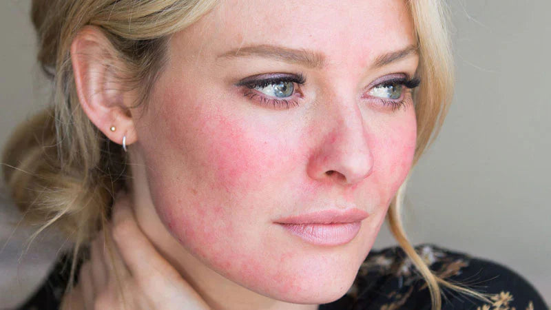 Rosacea Skincare Routine: How to Calm Redness & Strengthen Your Skin Barrier