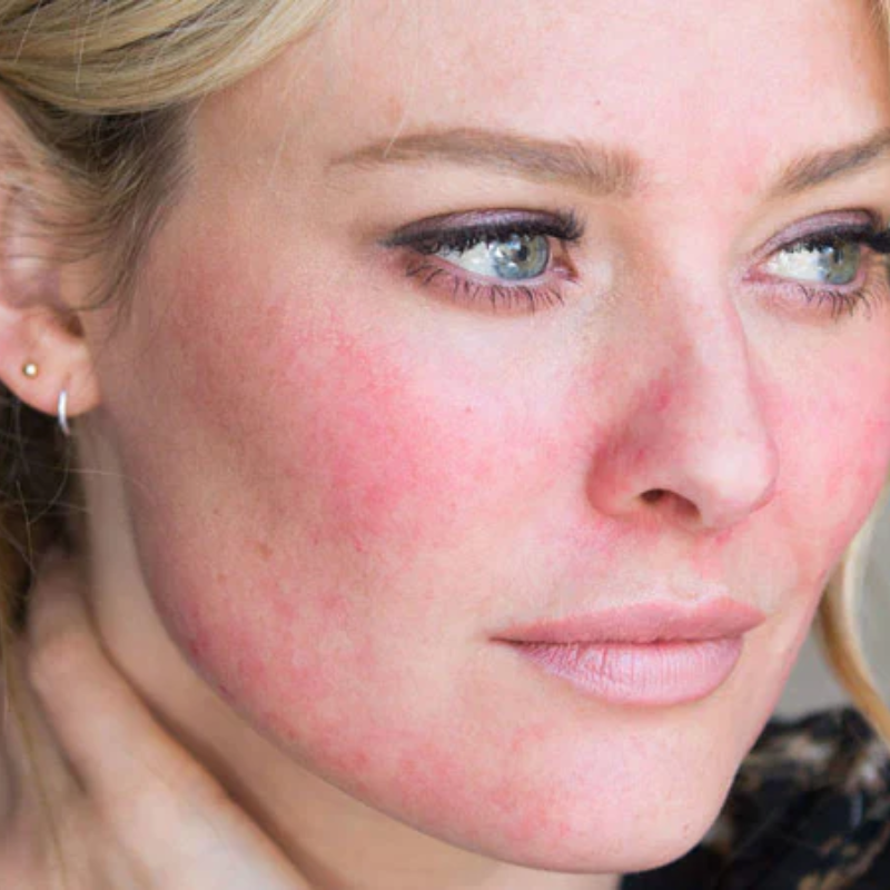 What Is Rosacea? Understanding the Causes, Symptoms & Best Ways to Manage It