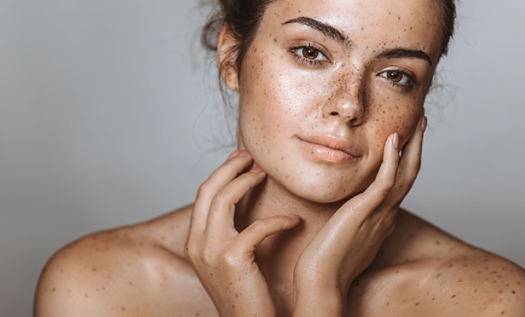 Hyperpigmentation