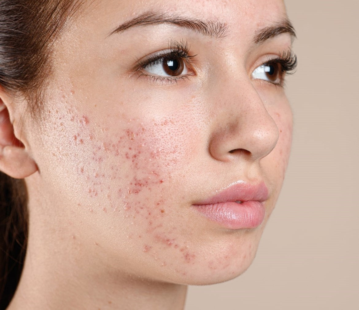 ACNE
